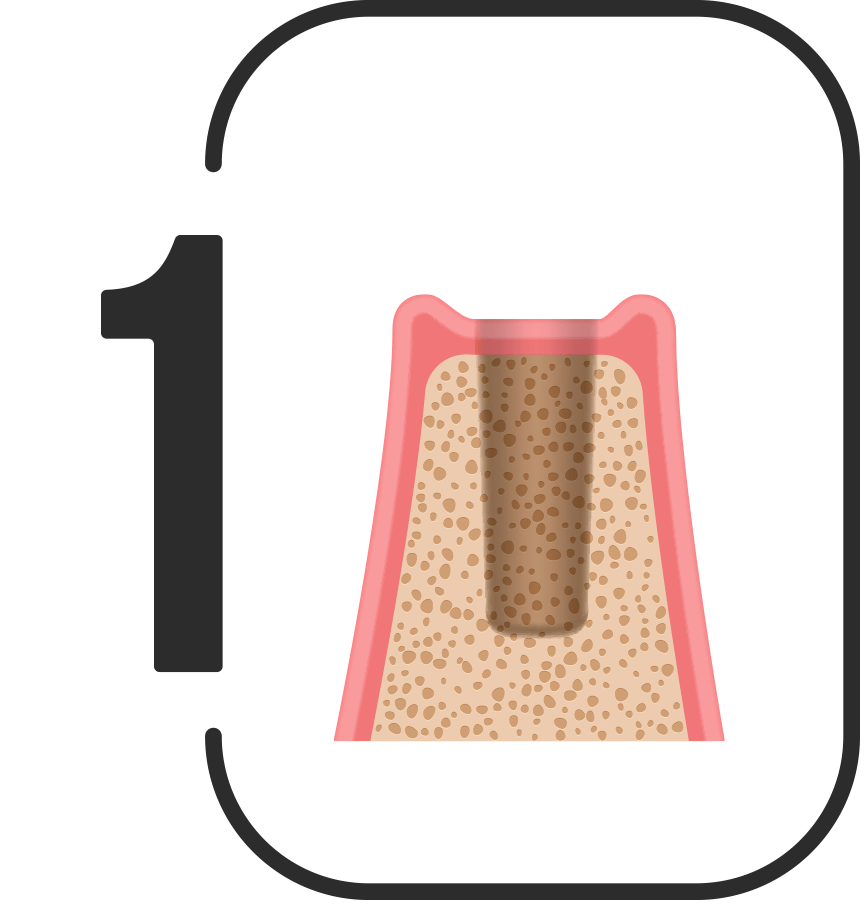 Dental implants in Northern Ireland