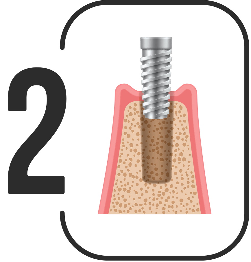 Dental implants in Northern Ireland