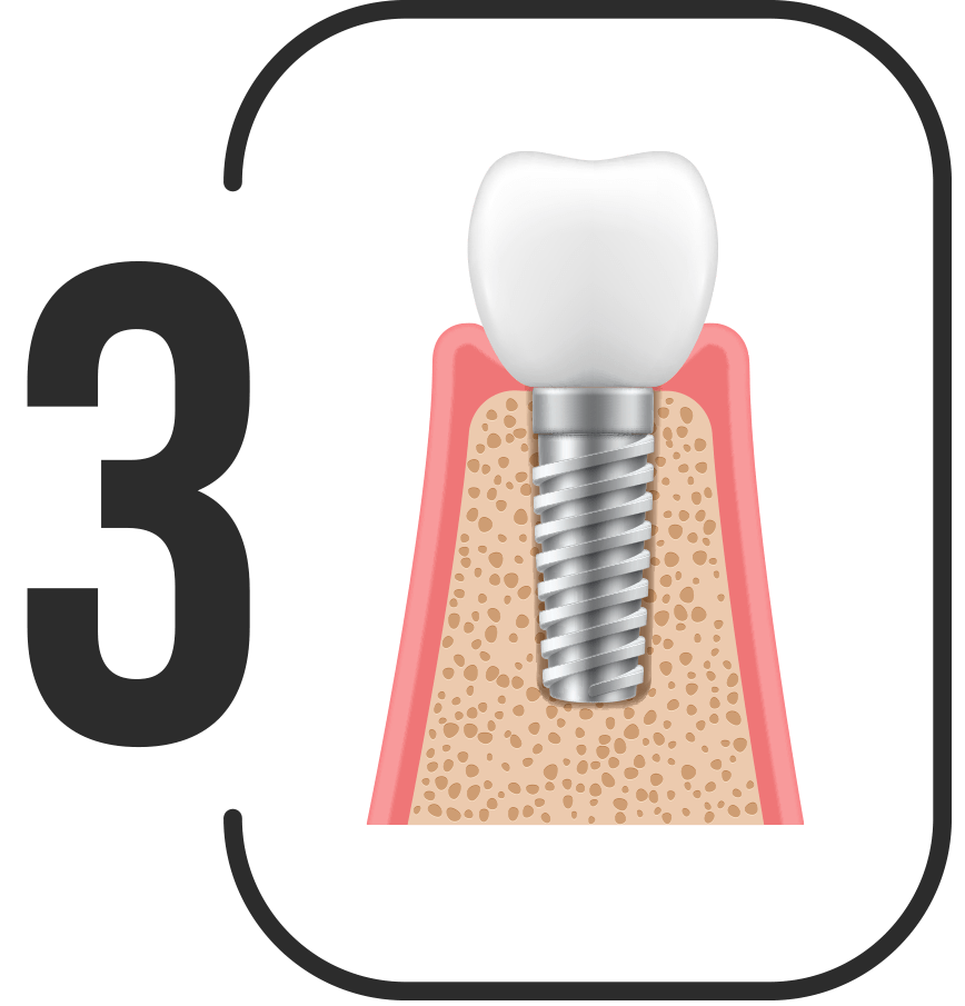 Dental implants in Northern Ireland
