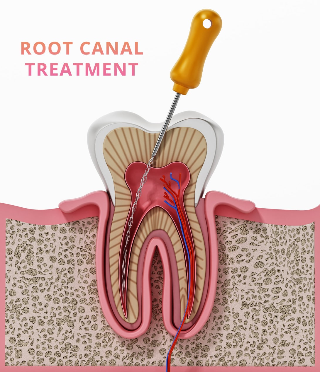 Root Canal Treatment