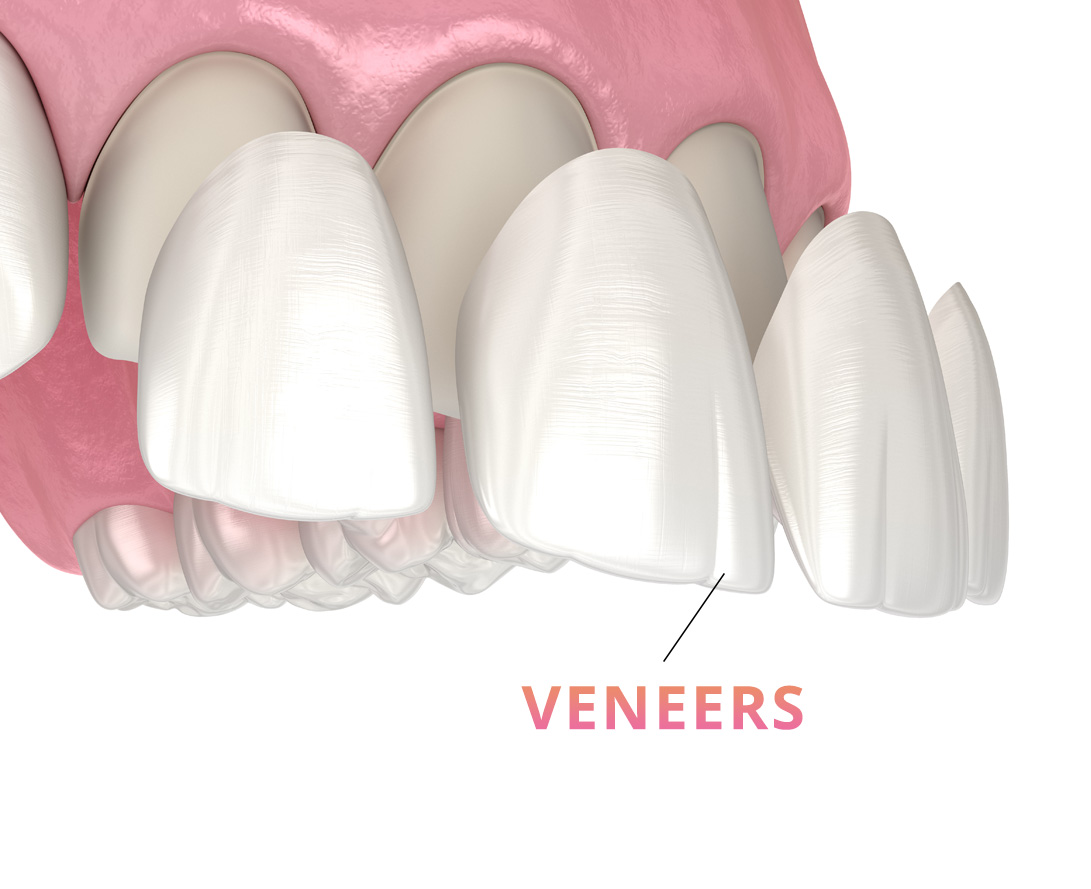 Veneers