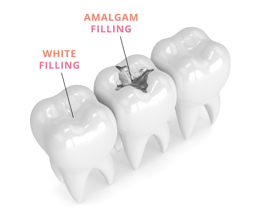 white fillings